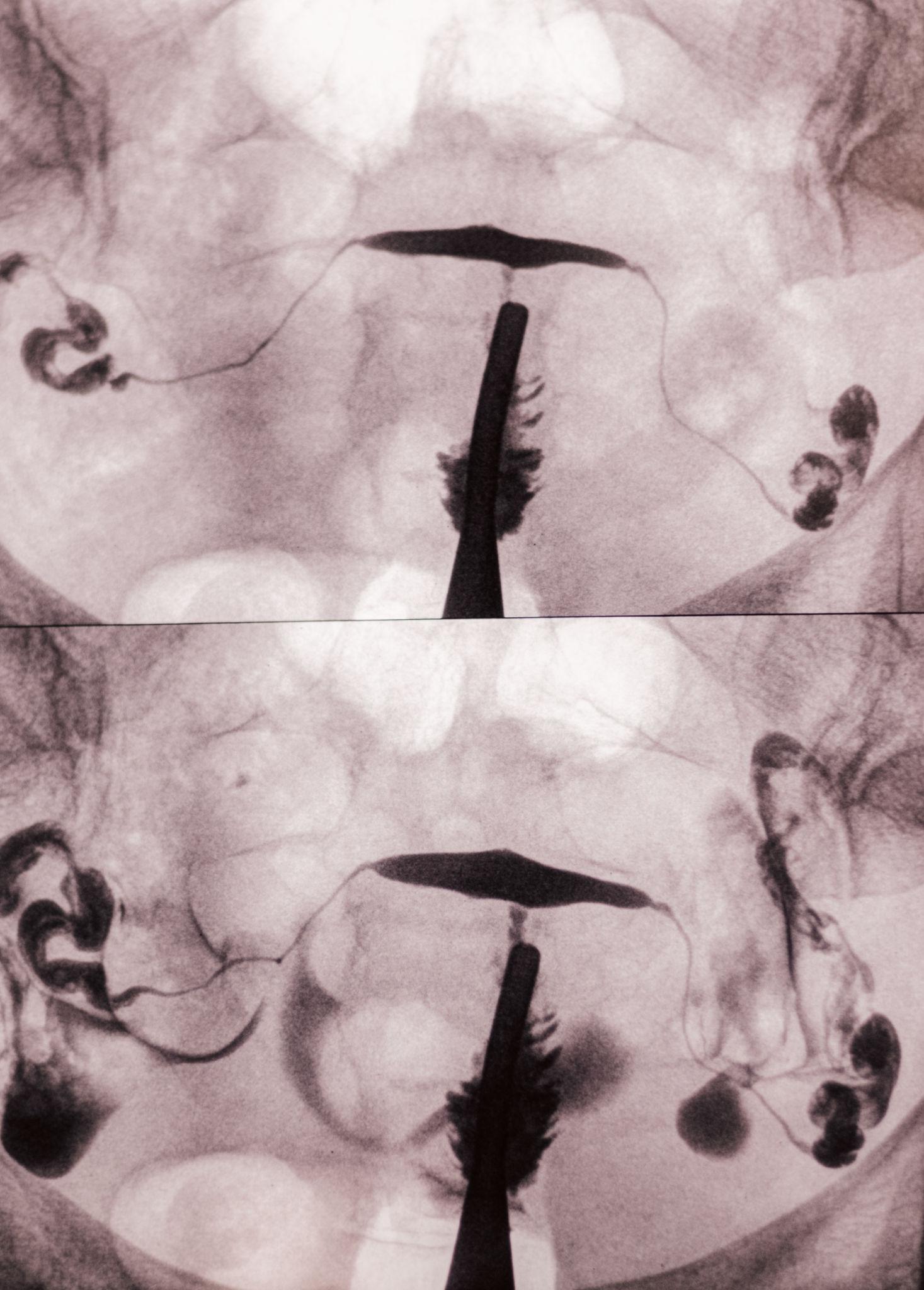 Hysteroscopic Tubal Cannulation in Pune – Advanced Treatment for Blocked Tubes